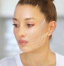 İple Yüz Germe (PDO Thread Lift)